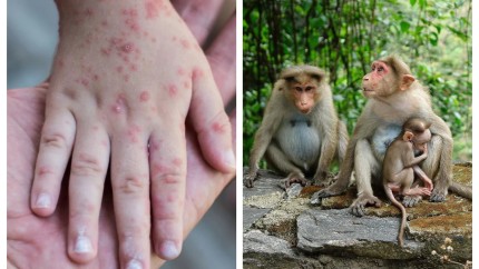 O altă boală gravă se extinde în Europa. Mai multe cazuri de variola maimuței în Spania și Portugalia