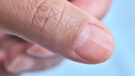 Striațiile pe unghii de obicei inofensive. Care ar putea fi câteva cauze posibile ale apariției lor