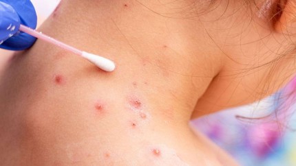 Aspecte importante despre varicelă. Ce trebuie să știi