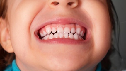 Cum putem preveni apariția cariilor Recomandările medicilor dentiști