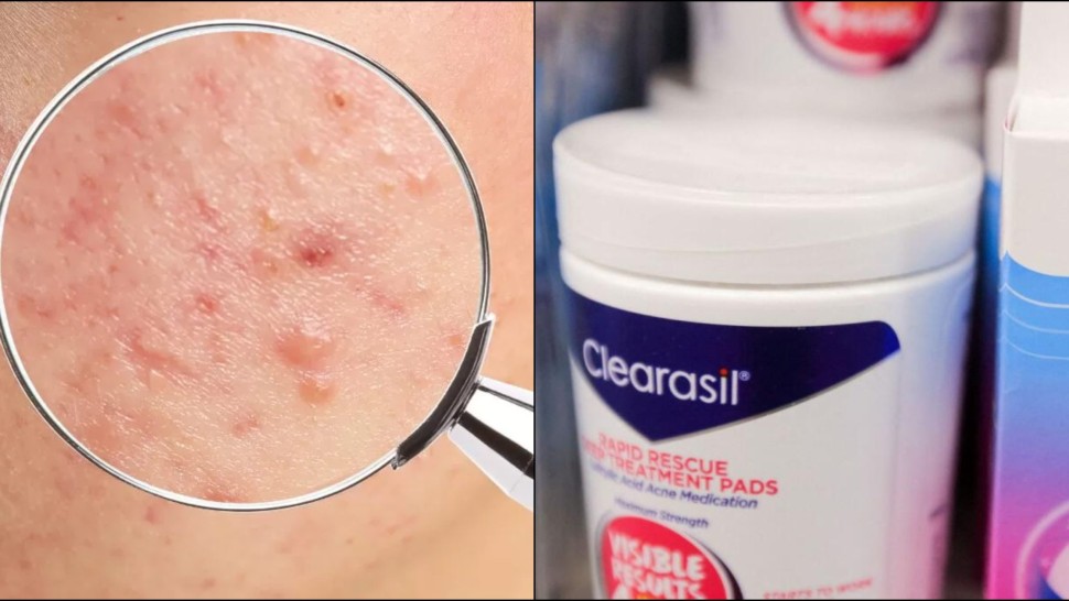 Reuters Tratamentele pentru coșuri și acnee Clinique și Clearasil conțin o substanță chimică cancerigenă arată un raport de laborator