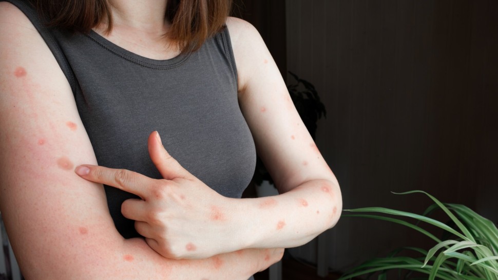 Autoritățile sanitare s-au reunit pentru variola mpox. Ce decizii au fost luate în legătură cu vaccinarea și controalele la frontieră