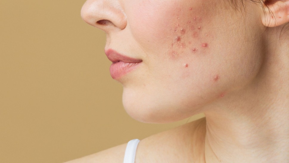 Acneea hormonală. Tot ce trebuie să știi despre ea