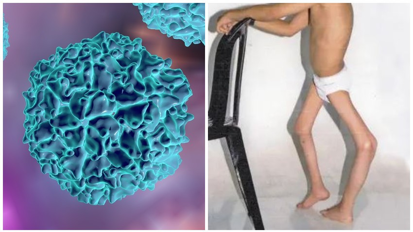 Alertă în București reapare paralizia acută flască și poliomielita Medicii de familie înștiințare de la DSP. România are risc înalt al bolii din cauza ratei scăzute de vaccinare