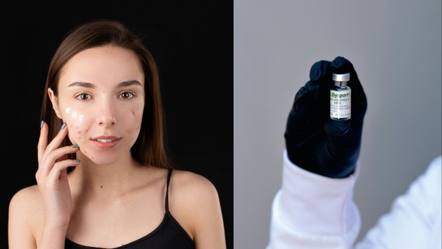 Vaccinul care ar putea înlocui toate tratamentele pentru acnee. Când va fi gata
