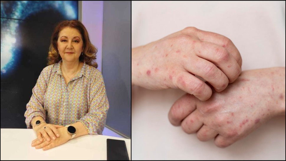 Prof. Univ. Dr. Simin Aysel Florescu noi detalii despre cazurile de lepră în România Nu este nimic tragic sau amenințător pentru populație