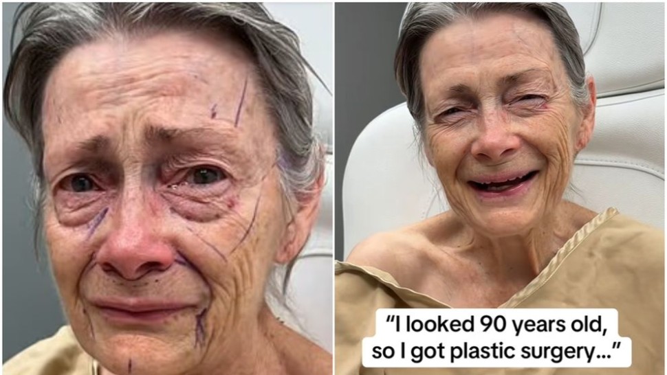 O femeie de 70 de ani și-a făcut lifting facial iar acum este de nerecunoscut. FOTO după procedură Medicul este omul-miracol