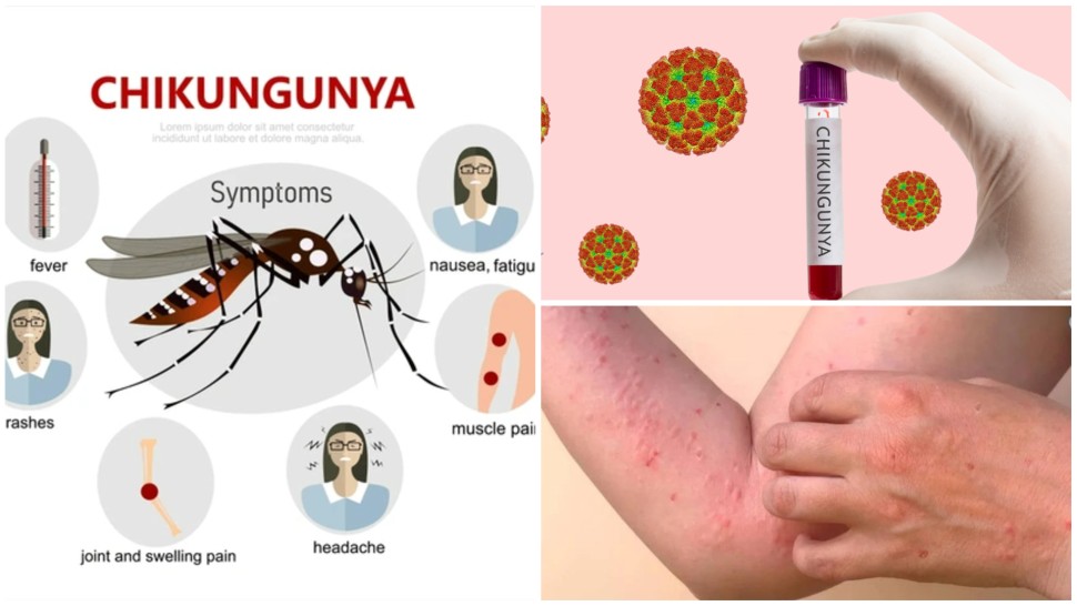 Un virus tropical care provoacă epidemii tot mai aproape de Europa. Simptomele infecției cu chikungunya