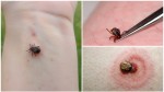 Ce trebuie să faci dacă găsești o căpușă pe tine pe copil sau pe animalul de companie