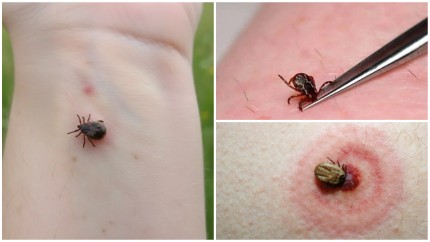 Ce trebuie să faci dacă găsești o căpușă pe tine pe copil sau pe animalul de companie