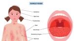 Scarlatină în instituțiile de învățământ din România. Un elev de 15 ani este internat la Spitalul de Boli Infecţioase