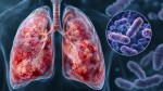 Ce este ciuma pneumonică și cum se răspândește. Rusia ține totul secret